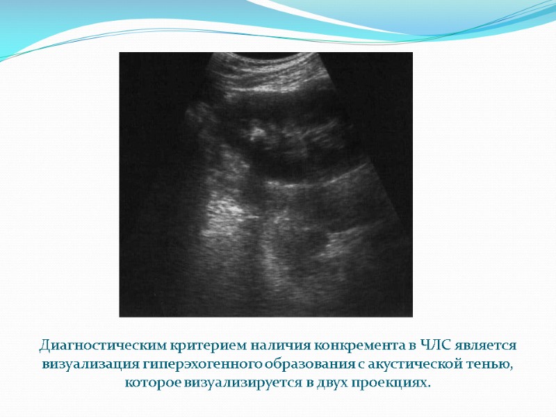 Диагностическим критерием наличия конкремента в ЧЛС является визуализация гиперэхогенного образования с акустической тенью, которое
